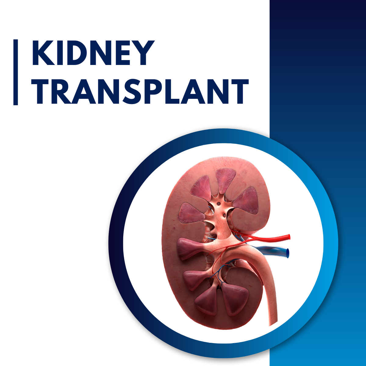 kidney transplant at einstagore hospitals